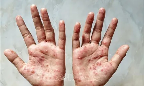 Bộ Y tế khuyến cáo người dân chủ động thực hiện các biện pháp phòng bệnh đậu mùa khỉ